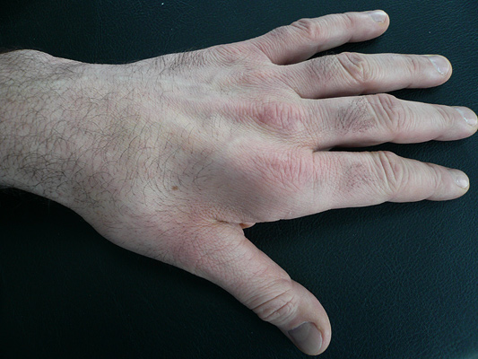 Linke hand ringfinger und kleiner finger taub